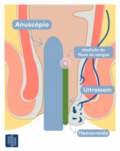 Técnica clássica mais realizada para cirurgia de doença hemorroidária
